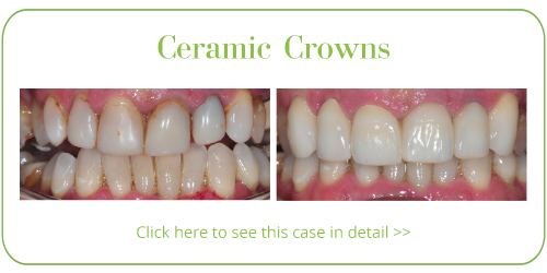 Ceramic Crowns Skegness